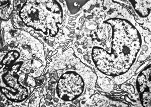 53. F,43y. | spleen - hairy cell leukemia 53. F,43y. | spleen - hairy cell leukemia
